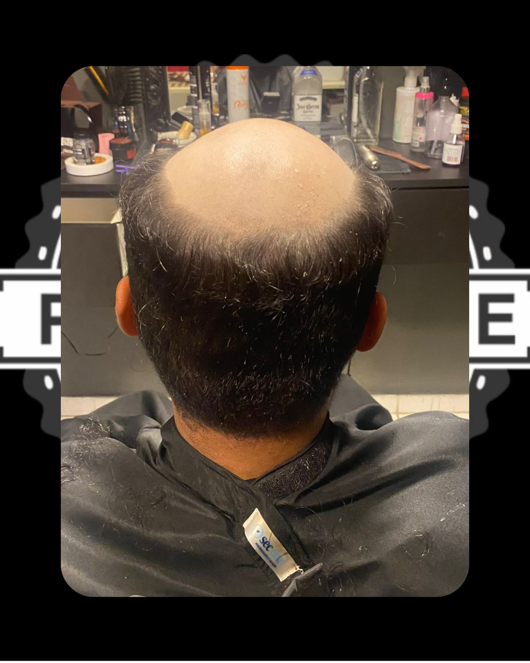 Antes do Procedimento